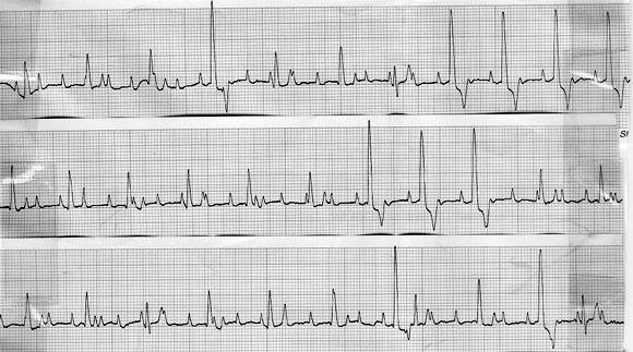 ECG 16