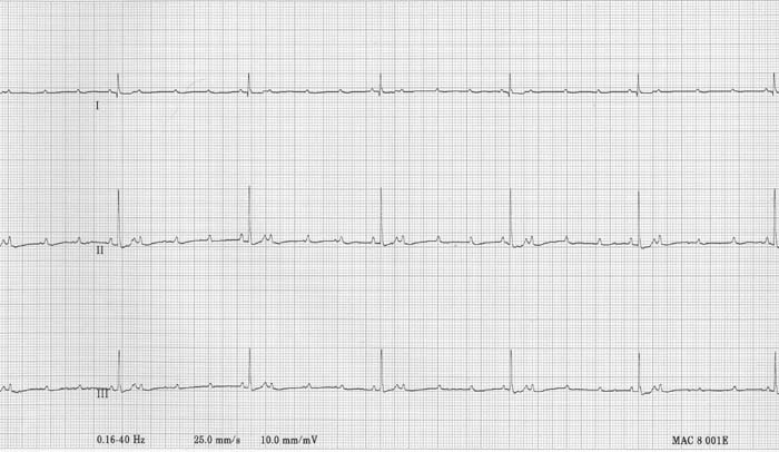 ECG 9