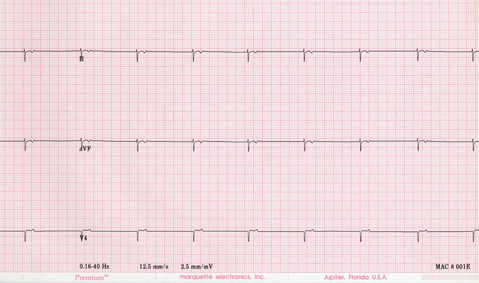 Atrial electrogram