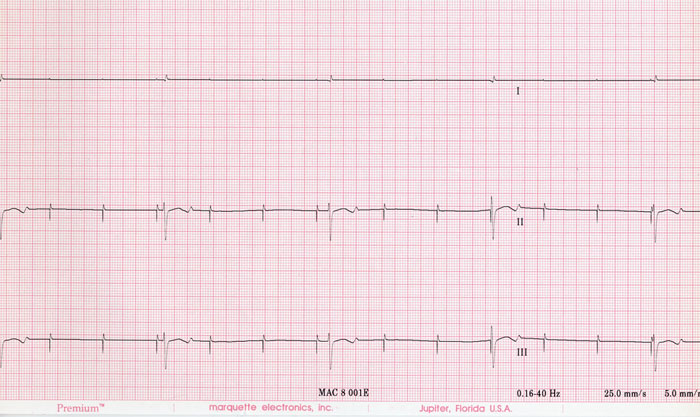 Atrial pacing