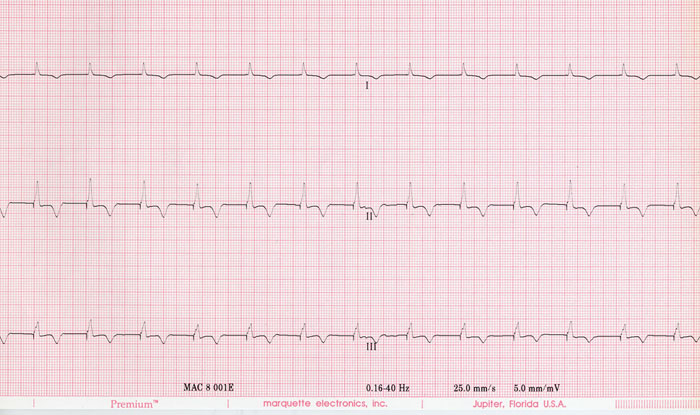 Ventricular pacing