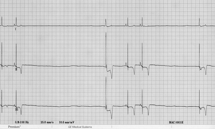 ECG 18