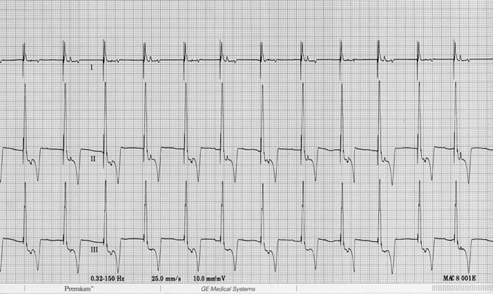 ECG 18 following therapy