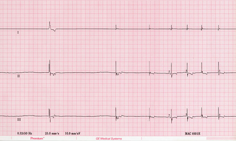 ECG 21 under anesthesia 2