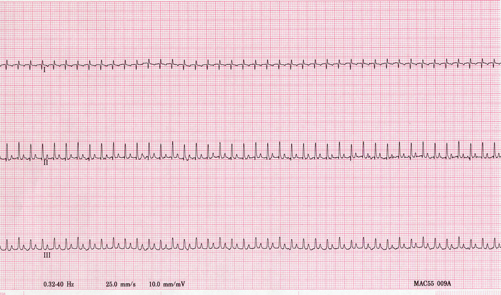 ECG 25 post atropine