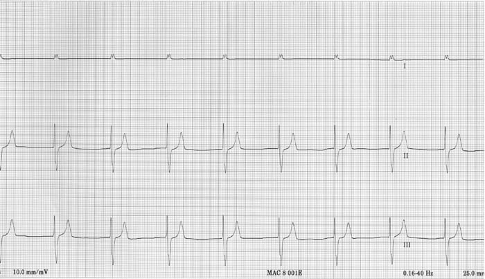 ECG 11
