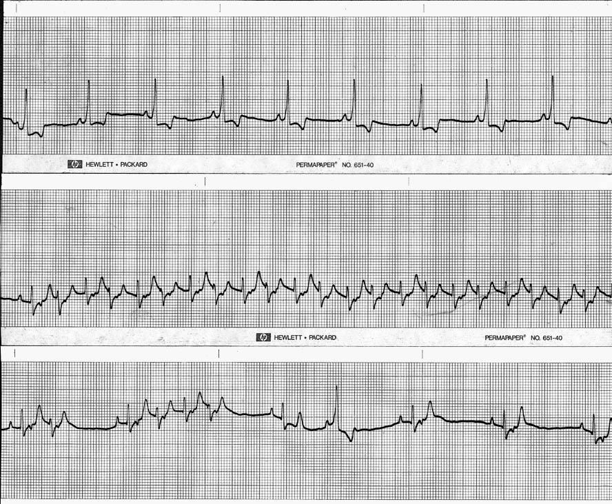 ECG 13