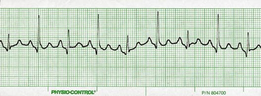 ECG 15