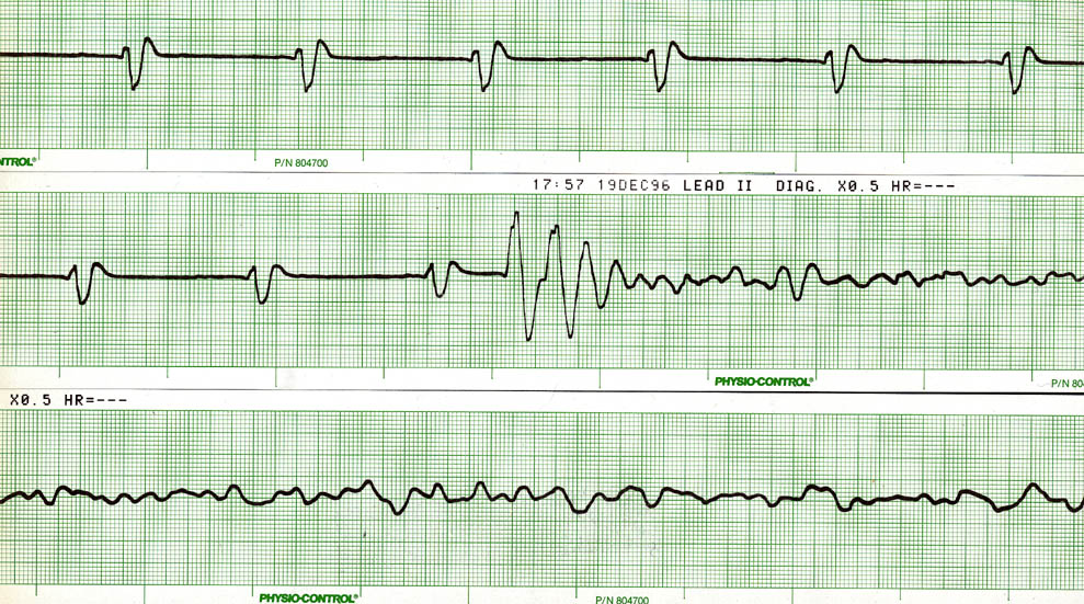 ECG 14