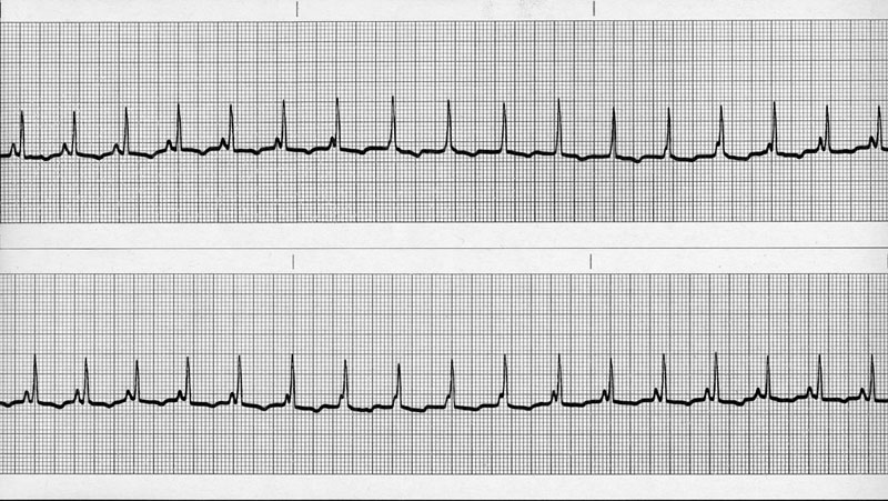 ECG 24