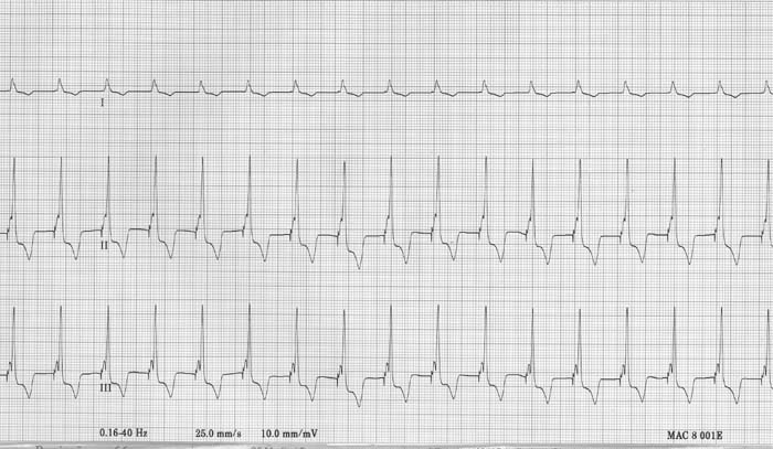 ECG 12