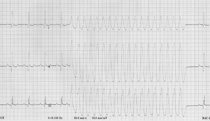 ECG 7