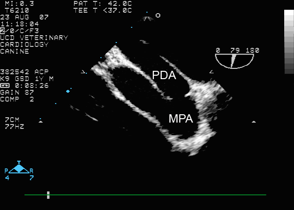 Two-dimensional transesophageal echocardiogram showing PDA