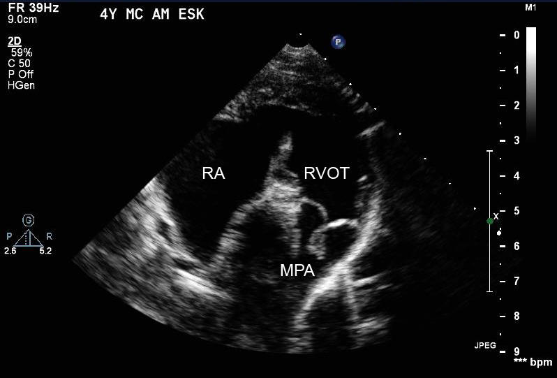 Two-dimensional echocardiogram - right parasternal short-axis basilar view