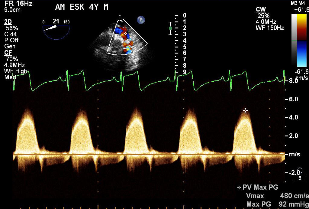 Continuous wave Doppler echocardiogram