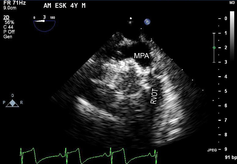 Two-dimensional echocardiogram - cranial transesophageal view