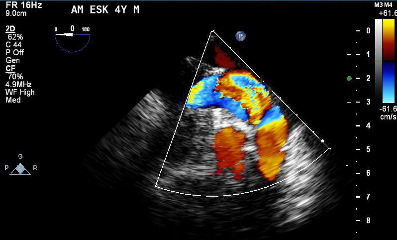 Transesophageal echocardiogram post balloon valvuloplasty color flow