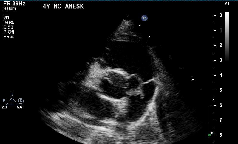 Transthoracic echocardiogram post balloon valvuloplasty