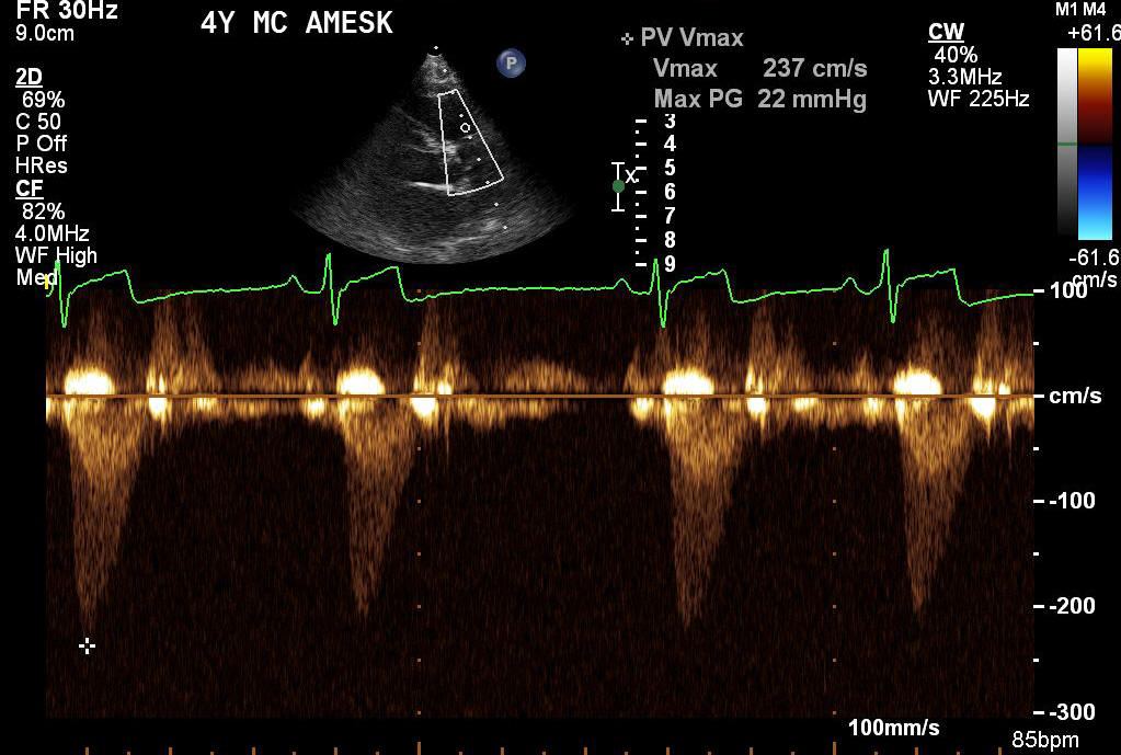 Transthoracic echocardiogram post balloon valvuloplasty - continuous wave Doppler