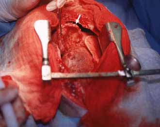 Surgical specimen showing the thickened pericardium being lifted toward the site of the median sternotomy. The dog is on its back with its head at the bottom and tail at the top. The arrow indicates the apex of the resected pericardium being flipped off the heart below.
