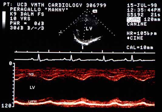 M-mode echocardiogram of the left ventricle showing markedly enlarged end-diastolic diameter of 7 cm (normal 4.7 cm) and moderately enlarged end-systolic diameter of 5 cm (normal 3.2 cm). Shortening fraction is 29%, within normal range (25-40%).