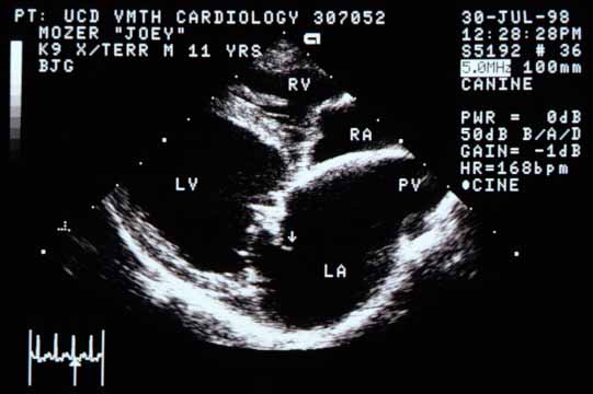 Right parasternal long-axis view of the four chambers. The left ventricular (LV) chamber appears enlarged. The left atrium (LA) is even larger. The right ventricle (RV) and right atrium (RA) may also be enlarged but not to the degree of the left heart. The septal leaflet of the mitral valve is markedly thickened. The pulmonary vein (PV) entering the LA is markedly distended. An arrow points to a structure originating from the mitral valve projecting back into the LA.