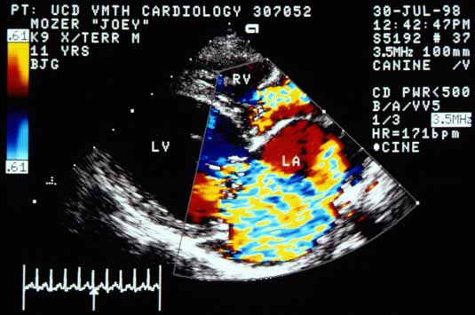 Color flow Doppler image in systole showing blood flowing from the left ventricle (LV) into the left atrium (LA). The jet is large, extending into the distended pulmonary vein. There is also a color jet emanating from the right ventricle (RV) into the right atrium, indicating tricuspid regurgitation.