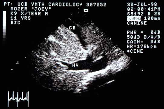 Abdominal ultrasound image of the liver showing a markedly distended proximal hepatic vein (HV) and caudal vena cava to the right. This appearance is typical of increased hydrostatic pressure in the hepatic veins and vena cava, consistent with congestive right heart failure. GB — gall bladder.