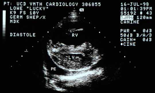 Cross-sectional view of the ventricles in diastole. The RV chamber is very large and the LV chamber is small. The interventricular septum is flattened, suggesting diastolic RV pressure is higher than LV pressure. PE — pleural effusion.