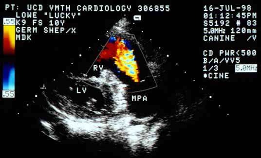 Diastolic color flow Doppler frame showing a jet originating at the pulmonic valve and flowing back into the RV — pulmonic regurgitation. The jet is not large enough to produce an audible diastolic murmur. MPA — main pulmonary artery.