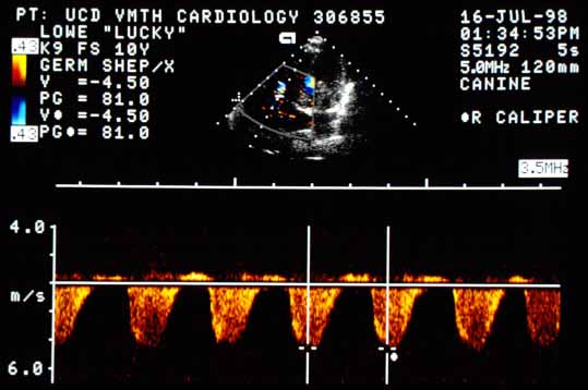 CW Doppler tracing of the tricuspid regurgitation jet showing a velocity of 4.5 m/s, corresponding to a pressure gradient of 81 mmHg across the tricuspid valve.