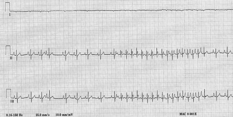 Three-lead ECG (I, II, III) showing deep S waves in leads II and III. Lead I QRS is completely negative though very small. All complexes are small, likely due to pleural effusion. Basic rhythm is sinus at ~100-120 bpm. The fourth complex is abnormal. After the ninth complex, a period of nonsustained tachycardia occurs.
