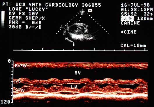 M-mode echocardiogram showing a markedly enlarged RV chamber with thickened RVFW. The LV chamber is small (~2 cm maximum diameter, ~5 ml volume). The IVS is flat in diastole then makes an abrupt motion toward the RV in early systole as the LV becomes round. End-systolic diameter approaches zero (end-systolic cavity obliteration).