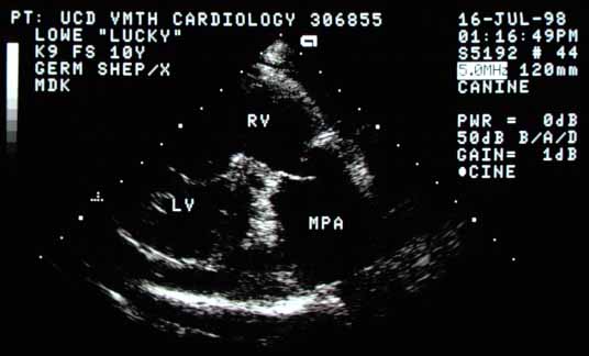 Non-standard echocardiographic view of the right ventricle (RV) and main pulmonary artery (MPA). The MPA is markedly enlarged, suggesting very high pressure or flow. One pulmonic valve cusp is open and appears moderately thick.