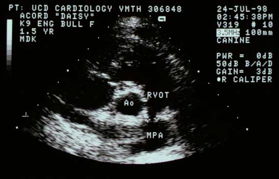 Right parasternal short-axis view at the base with electronic calipers measuring the pulmonic valve annulus orifice size, which is small. RVOT — right ventricular outflow tract; Ao — aorta; MPA — main pulmonary artery.