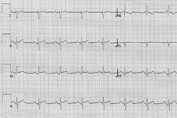 Six limb lead ECG recorded at 50 mm/second with calibration signal.