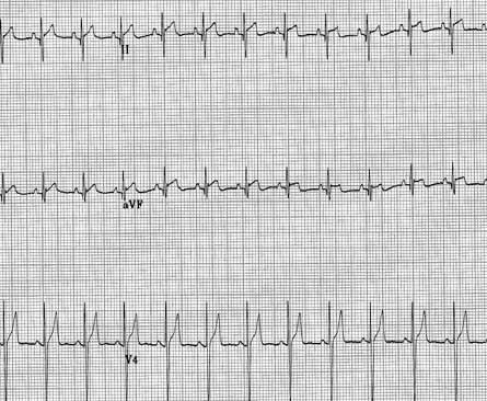 Additional ECG leads including chest lead V4 (CV6LU).