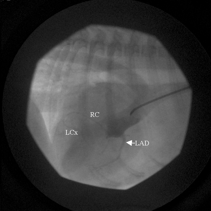 Labeled version of the aortic root angiogram. The left anterior descending (LAD) coronary artery is the largest, descending down the front of the heart. The right coronary (RC) artery is dorsal and normal. The left circumflex (LCx) coronary artery is fed by a small branch that courses ventrally then horizontally.