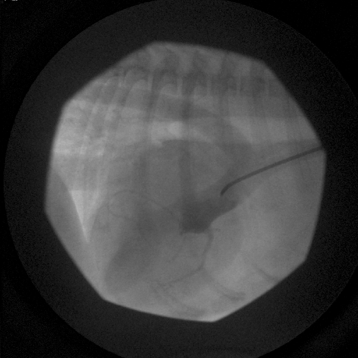 Aortic root angiogram showing contrast injected into the proximal ascending aorta. Only one coronary ostium is visible with all coronary branches originating from it.