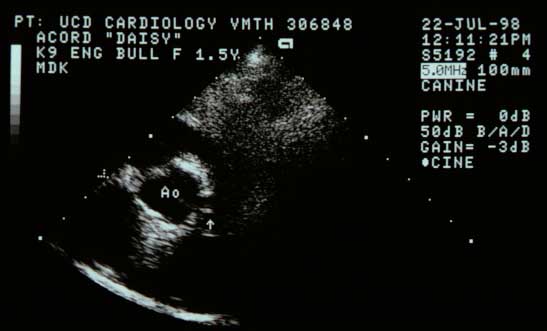Transthoracic echocardiogram showing one large coronary ostium (arrow). No other ostia could be identified. The ostium is abnormally positioned but appears to originate from the right coronary sinus.
