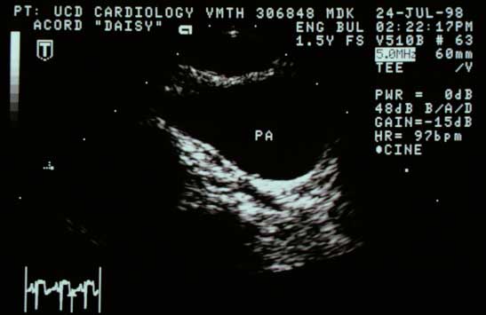 Transesophageal echocardiogram showing the coronary vessel appearing to divide at this point.