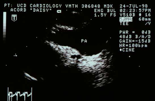Transesophageal echocardiogram of the dilated main pulmonary artery (PA) showing a coronary artery coursing around the PA. The vessel could be traced back to its origin at the aorta where there appeared to be only one ostium. The vessel appears to course behind the PA, between it and the aorta.