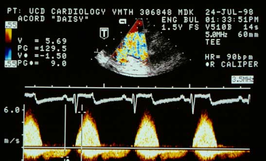Continuous wave Doppler tracing taken via a transesophageal probe while the dog was anesthetized. The CW cursor is placed across the RVOT and MPA in the turbulent jet. Peak systolic velocity is 5.7 m/s, translating to a pressure gradient of 129 mmHg. 60-cycle interference is present on the ECG trace.