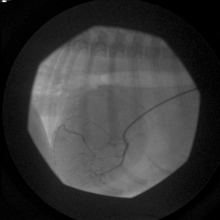 Selective angiogram with catheter in the right coronary ostium. All coronary branches fill simultaneously. The LAD originates from the right ostium. The LCx is fed by a small branch from the LAD and collateral vessels. The upper small branch appears to wrap around the pulmonic valve region.