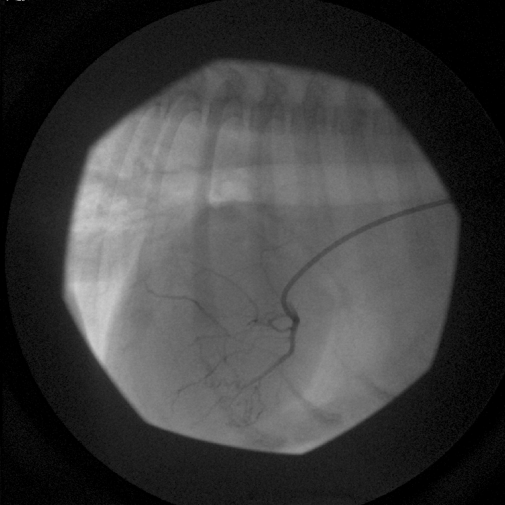 Additional angiographic frame taken in systole. The LCx feeder branch has moved dorsally, creating an appearance of encircling the pulmonic valve region.