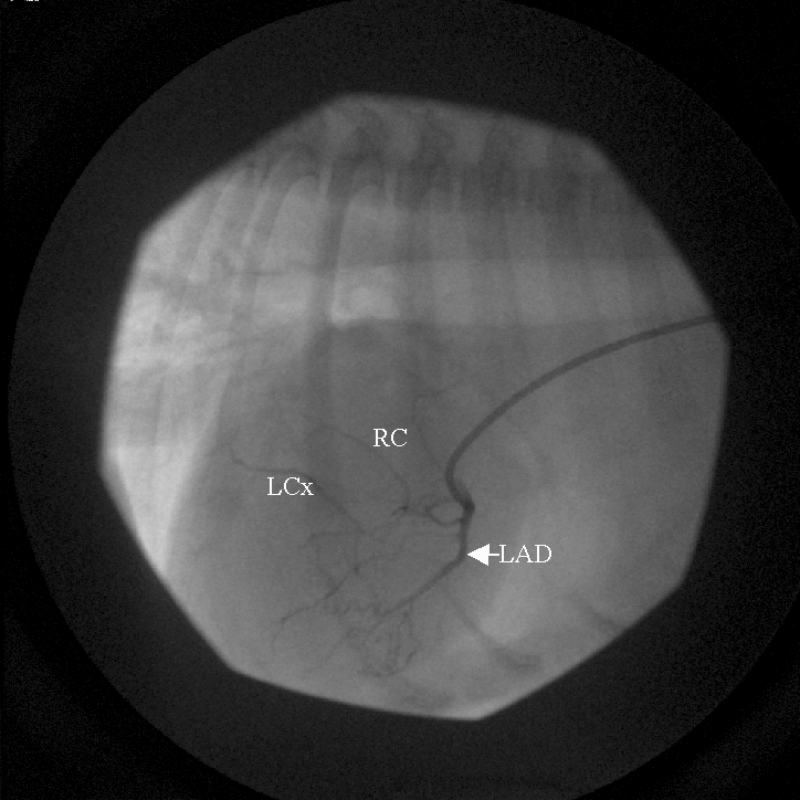 Labeled systolic frame. In systole, the LCx feeder has moved dorsally creating an illusion of connecting to the RC artery and encircling the pulmonic valve region. LAD — left anterior descending.