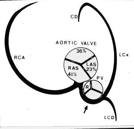 Schematic diagram of the R2A coronary artery anomaly. There is only one coronary ostium originating from the right coronary artery sinus (RAS). The right coronary artery courses normally. The left coronary artery also originates from the right ostium, coursing cranially over the junction of the RVOT and pulmonary artery, right at or just below the pulmonic valve region where the stenosis occurs.