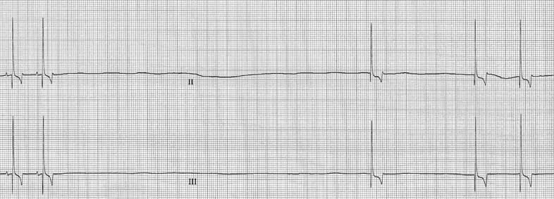 ECG recording from the second visit, also taken after atropine administration. Shows more pronounced sinus arrest with long pauses and infrequent escape beats.