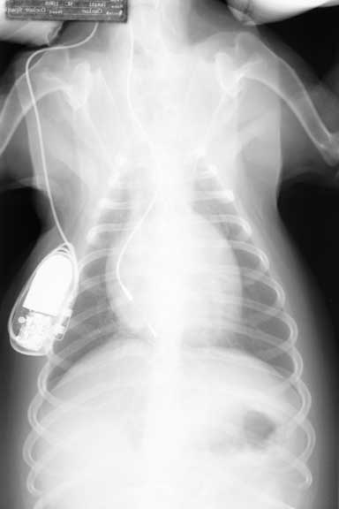 DV thoracic radiograph taken one day after pacemaker implantation showing the lead and generator well-positioned.
