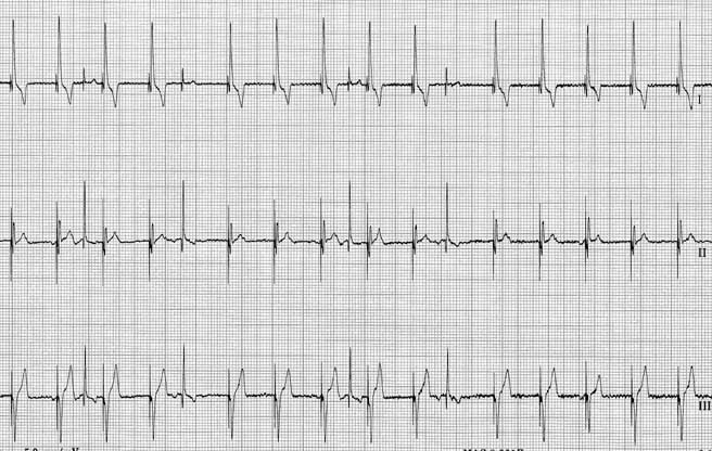 ECG recorded later the same day showing the VVI pacemaker intermittently failing to sense spontaneous sinus beats. Some spontaneous beats are sensed and reset the pacemaker correctly, while others are not sensed and the pacemaker continues at its set rate. The sensitivity setting was adjusted to resolve this issue.
